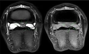 Op deze MRI-beelden wordt met pijlen de verklevingen en de scheur in de diepe buigpees aangegeven